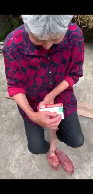 灰指甲很多年，今天终
