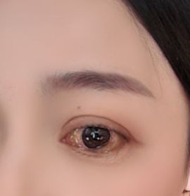 璐儿眼睛发炎了的图片