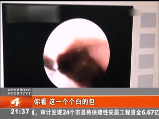 偏方要命：迷信偏方 过敏性鼻炎患者鼻腔藏虫卵
