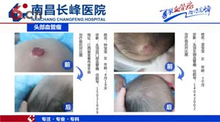 南昌长峰血管瘤医院头面部血管瘤治疗案列