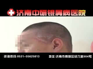 济南中研银屑病医院好吗