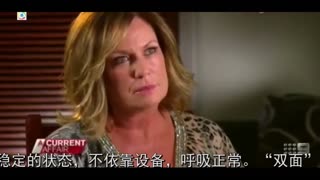澳大利亚女子生下罕见“双脸婴”