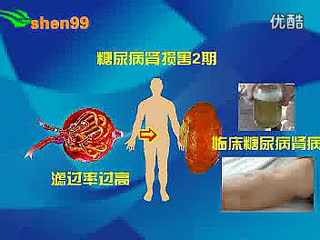 糖尿病肾病分期及表现.flv